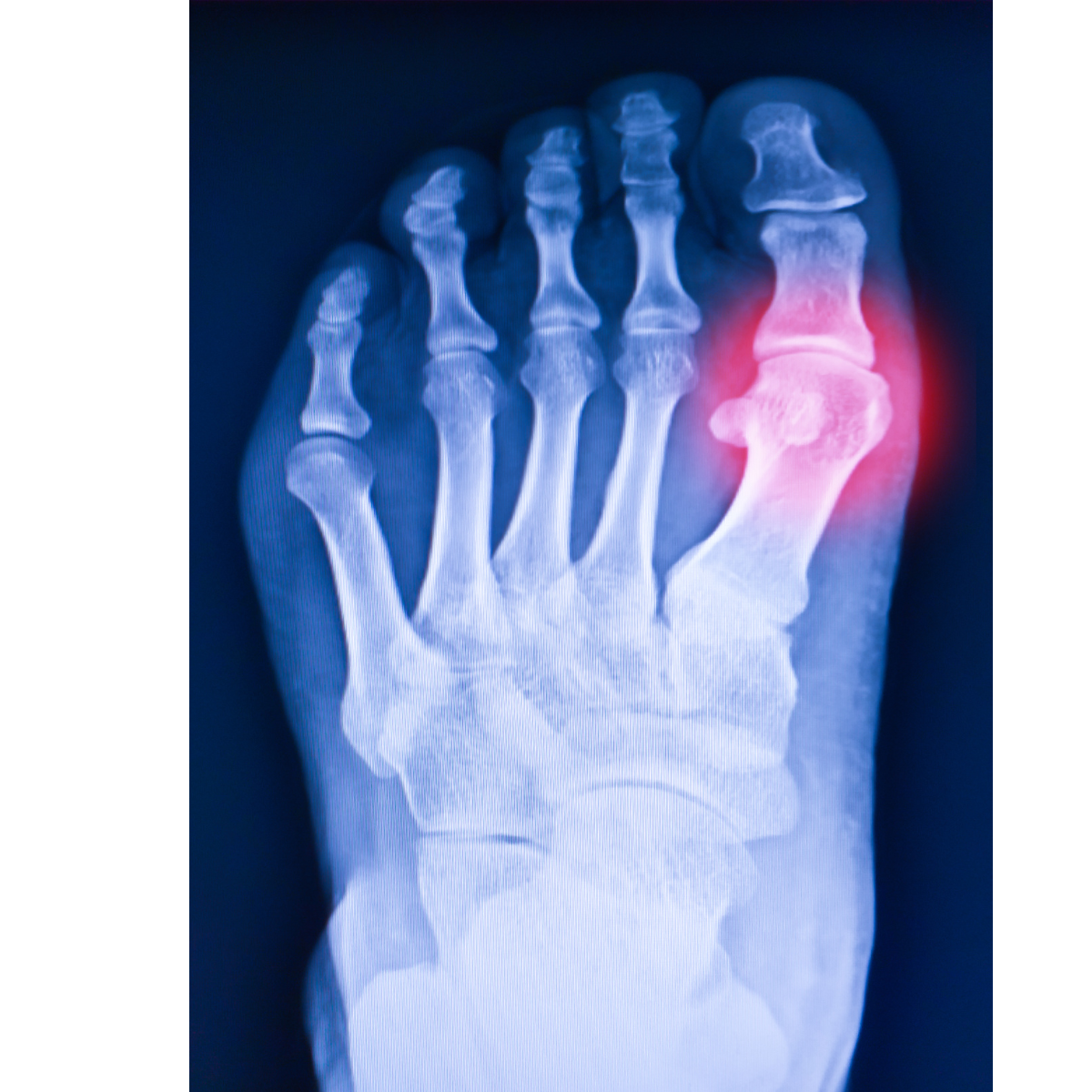 Gout and Its Dangerous Complications: Don’t Ignore the Warning Signs