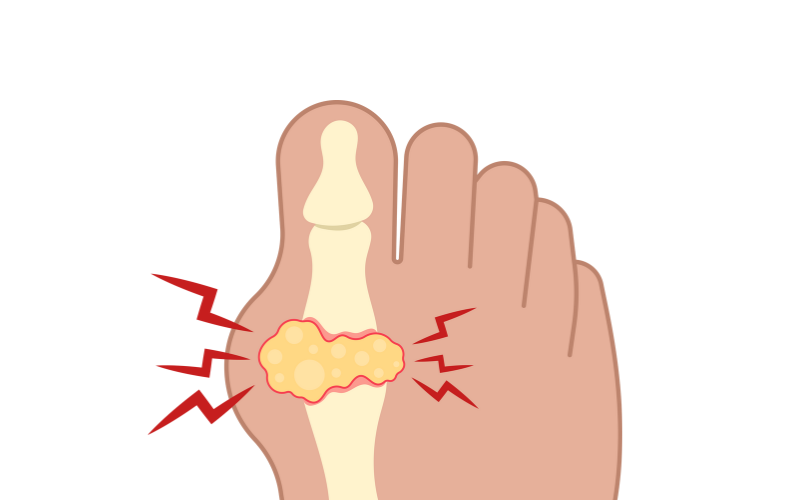 What Is Gout? Causes and Symptoms You Need to Know