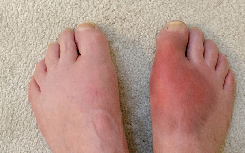 Can Gout Be Completely Cured?