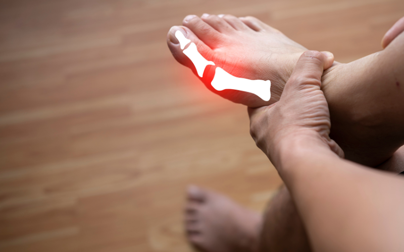 Serious Complications of Gout If Left Untreated